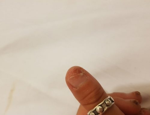 פטרת ציפורניים מה זה ואיך נפטרים מזה?